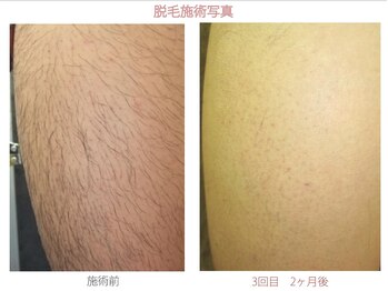 ロイ 梅田茶屋町店(LoY)/あし脱毛