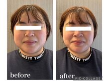 ネオファースト 大阪福島店(NeoFirst)/4Dフェイシャル#毛穴#毛穴洗浄