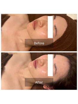 天使の艶肌/お悩み「毛穴の詰まり」