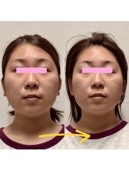 アレイズ/小顔矯正コース