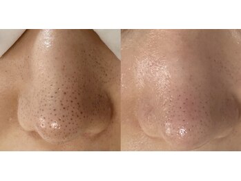 エミナル(eminal)/ビフォー/アフター/毛穴/梅田