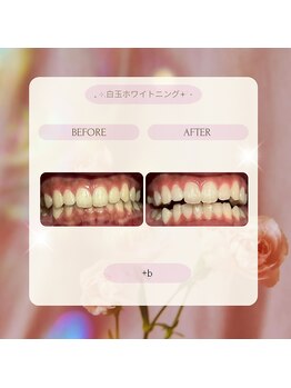 プラスビー 2号店(+b)/ホワイトニングビフォーアフター