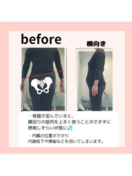 エミフル(EMIFULL)/骨盤の歪みと腰回りの脂肪