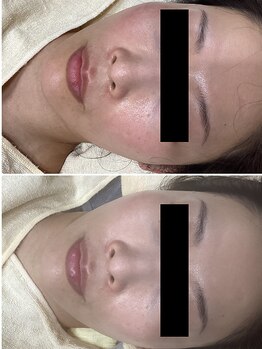 フォーユー 飯能店(Foryou)/糸フェイシャルエステ