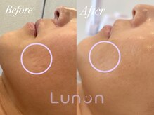 ルノン(Lunon)/ララピール