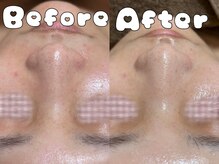 グラシア 倉敷店(Gracia)/ハイドラ毛穴洗浄