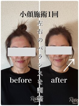 リバイブ 自由が丘店(REVIVE)/小顔矯正+ドライヘッドスパ1回