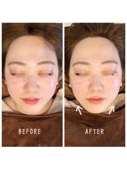 デジール(DESIR)/大口式プレミアム小顔矯正