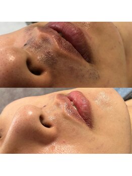 スピカ(Spica)/ヒゲ脱毛卒業!!ツルツルに♪