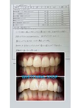 ホワイトニングショップ 久留米店(WHITENING SHOP)/ビフォーアフター