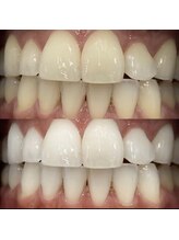 ホワイトニングセンター 大阪茨木店/高槻・茨木ホワイトニング