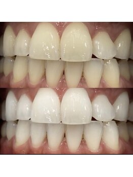 ホワイトニングセンター 大阪茨木店/高槻・茨木ホワイトニング