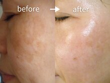 アルカンシエル(arcenciel)/シミ・シワ改善コース