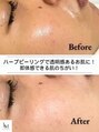 ベル 新潟(Belle)&nbsp;1回でお肌 白玉肌★