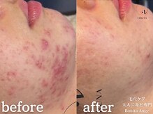 ボニータアンジュ 恵比寿(Bonita Ange)/恵比寿ハーブピーリング｜症例
