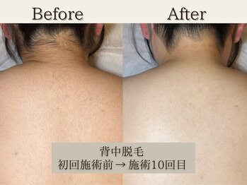 インベスト(INVEST)/背中脱毛