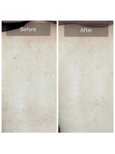 エミルカ 日の出平井店(EMILUCA)/背中ブツブツもハーブピーリング