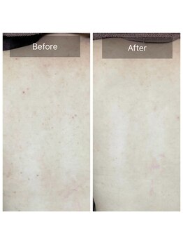 エミルカ 日の出平井店(EMILUCA)/背中ブツブツもハーブピーリング