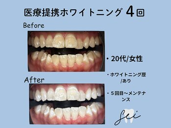 セイ(sei)/ホワイトニングビフォーアフター