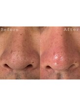 オアシス 一宮(Oasis)/毛穴洗浄で黒ずみ&角質除去！