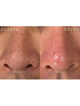 オアシス 一宮(Oasis)/毛穴洗浄で黒ずみ&角質除去!