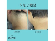 アクト クロ(ACT curro)/【うなじ襟足】脱毛施術例