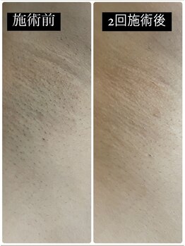 リノ(Lino)/ワキ脱毛経過写真