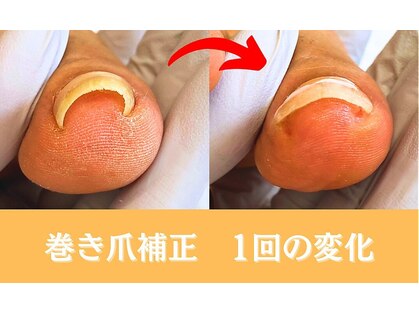 巻き爪専門ラボ 豊田店の写真