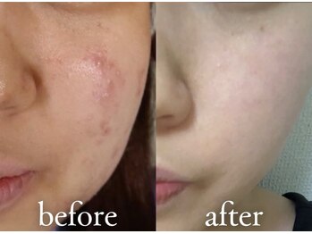 エトワール 横浜馬車道店(ETOILE)/肌質改善|ニキビ・毛穴ケア