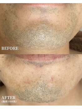 エースビューティーサロン 蒲郡店(ACE. beauty salon)/髭を生やしたい部分を生かせます