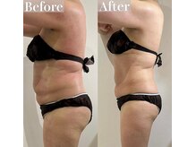 ヴィクシア(VIXIA)/痩身90分