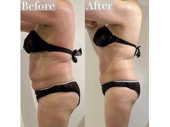 ヴィクシア(VIXIA)/痩身90分