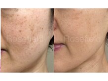 ローズフィールド(Rosefield)/40代　シミ・毛穴（1年）