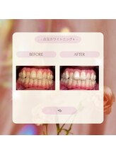 プラスビー 2号店(+b)/ホワイトニングビフォーアフター