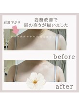 アリサナ(Arisana)/症例写真　バスト　葛西