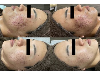 ラヴィアンローズ 泉店 (La vie en Rose)/イロンハーブピーリング