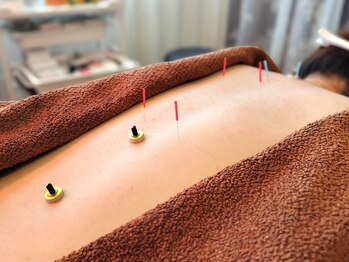 はりキュア(はりCure)/はりきゅう施術