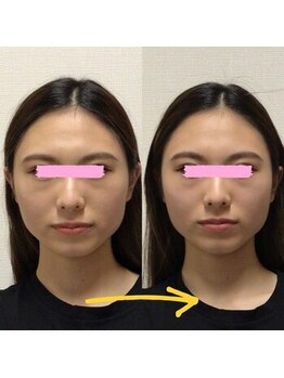 アレイズ/小顔矯正コース