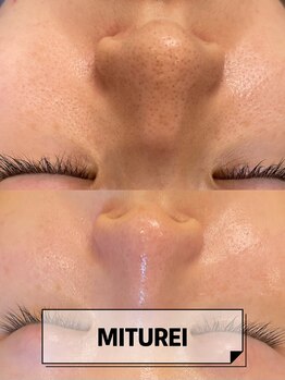 ミツレイ 九条店(MITUREI)/ハーブピーリングx毛穴洗浄