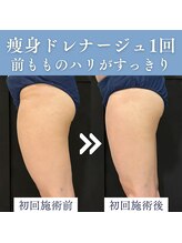 エミーニー(emiiny)/痩身ドレナージュ1回