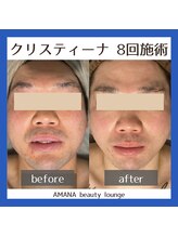 アマナ(AMANA)/乳酸菌&ハーブ両方試された方♪