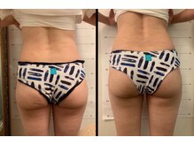 美尻研究所 心斎橋店/凸凹尻だったのに丸みがでてきた