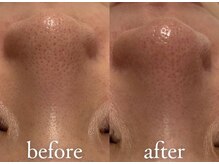 エトワール 横浜馬車道店(ETOILE)/肌質改善|毛穴ケア