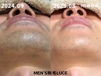 ルーチェ/【ヒゲ脱毛】第一印象UP★