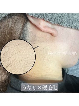 サロンロン 横浜関内(SALON RON)/うなじ硬毛化/美容電気脱毛