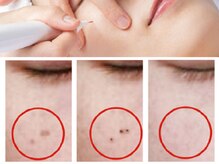 ビューティーリバース 相模大野店/シミケア美白！オセロマシン