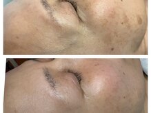 エスボーテ(sbeaute)/最新光フェイシャル