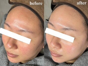 ユネ(une)の写真/【韓国肌管理"ダクトピール"】SNSで話題沸騰!剥離とダウンタイムのない次世代ピーリングで憧れの水光肌に★
