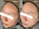 ユネ(une)の写真/【韓国肌管理"ダクトピール"】SNSで話題沸騰!剥離とダウンタイムのない次世代ピーリングで憧れの水光肌に★