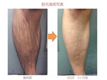 ロイ 梅田茶屋町店(LoY)/あし脱毛